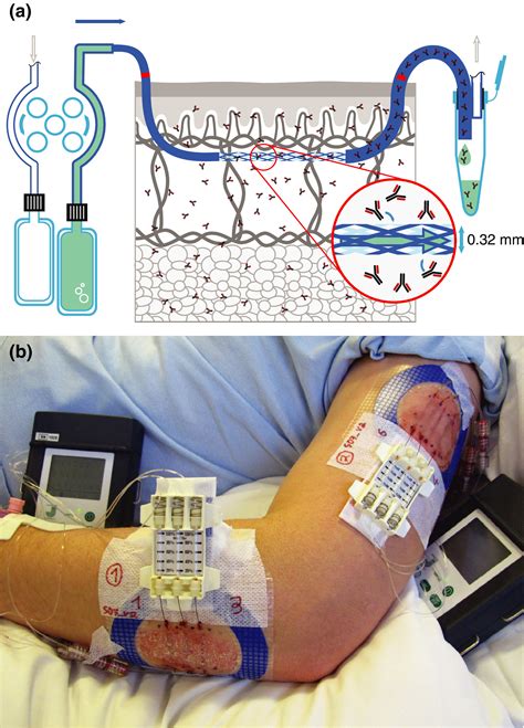 interstitial fluid measuring less than 1 mm thick|dermal interstitial fluid.